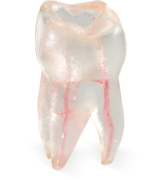Endo 3DP™#03 Accessed Molar (UR6)