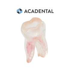 Endo 3DP™#19 Accessed Molar (LL6)