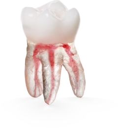X2 Endo™#03 Molar (UR6)